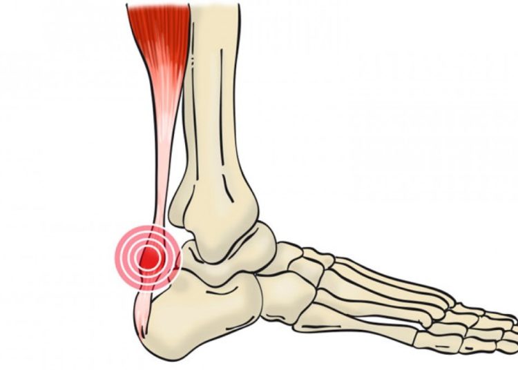 ¡Cuidado!  con la tendinitis aquileana