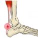 ¡Cuidado! con la tendinitis aquileana
